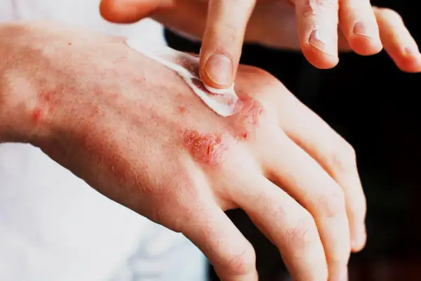 Alergia na sierść objawy skórne – jak je rozpoznać i leczyć